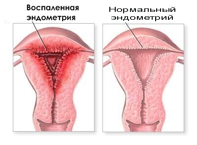 ендометрит запалення матка слизова оболонка підвищення температури гнійні виділення піхву гостру хронічну причини симптоми лікування