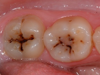 фіссурний карієс поглиблення зуби пломбування вкладки закриті відкриті причини симптоми лікування