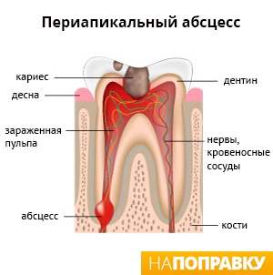 флюс (дентальний абсцес)