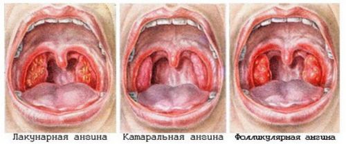 як збити температуру при фолікулярну ангіну