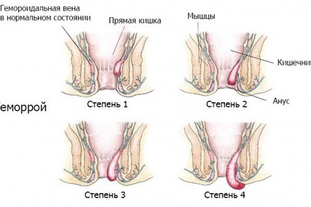 як лікувати хронічний геморой 2 ступеня