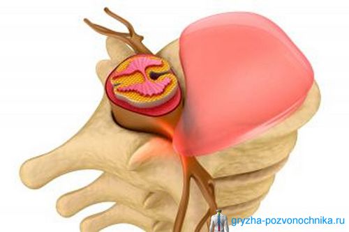 діагностика грижі спини