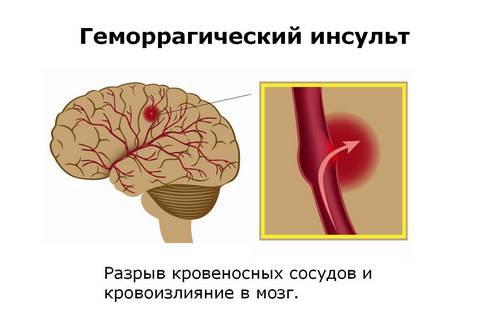 як лікувати правобічний інсульт