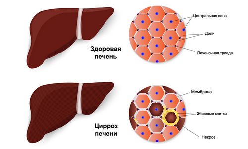 як лікувати печінку при алкоголізмі