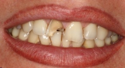 як лікувати карієс збоку зуба