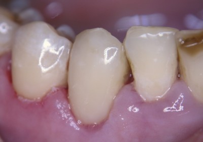 як лікувати карієс збоку зуба