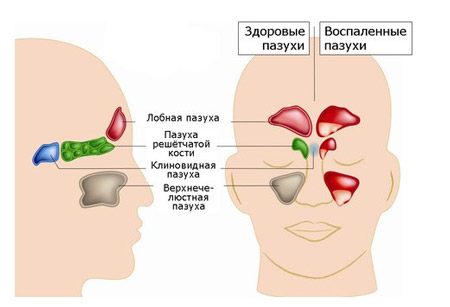 як лікувати кісту в гайморової пазухи