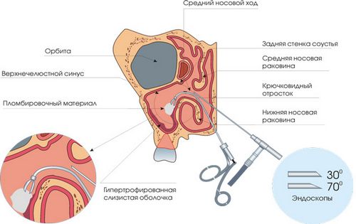 як лікувати кісту в гайморової пазухи