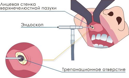 як лікувати кісту в гайморової пазухи