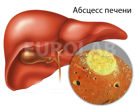 як лікувати абсцес печінки