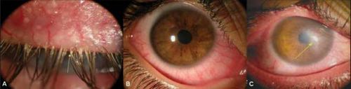 демодекоз століття лікування очей фото як лікувати демодекс очної вій