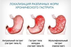 як лікувати гастрит вівсом