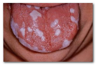 як лікувати запалення язика народними засобами