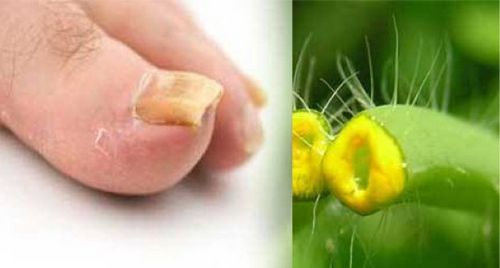 народний метод лікування грибка нігтів на ногах