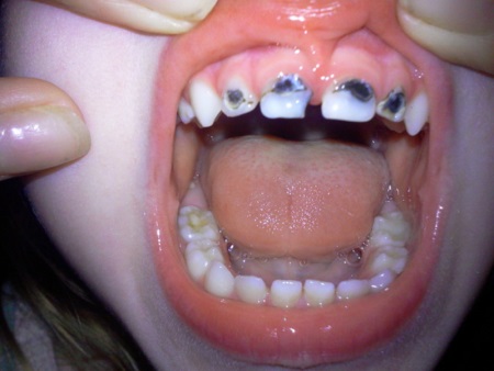 як вилікувати карієс молочних зубів