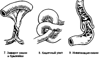 як лікувати непрохідність кишечника