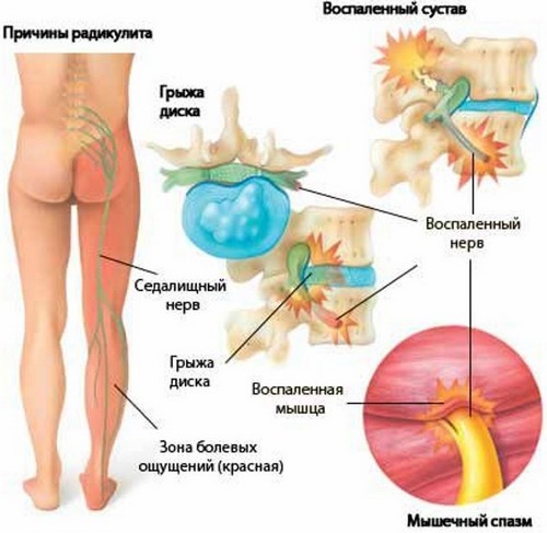 як лікувати радикуліт попереку