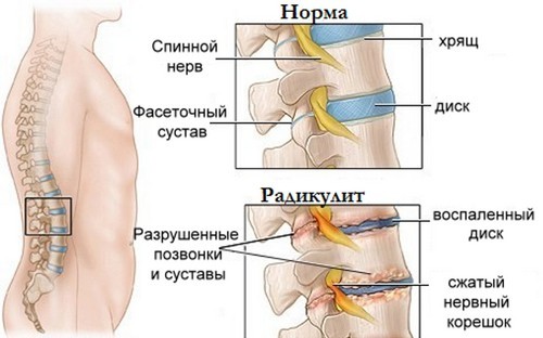 як лікувати радикуліт попереку