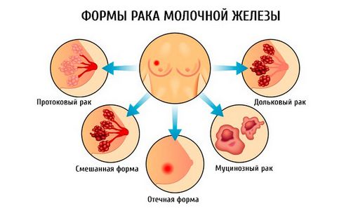 як лікувати рак молочної залози