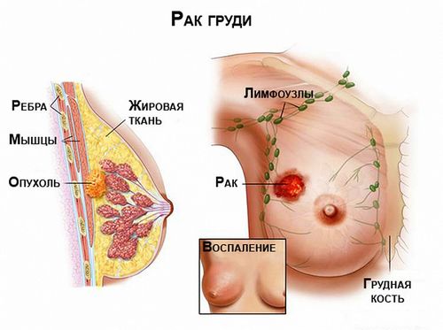 як лікувати рак молочної залози народними засобами