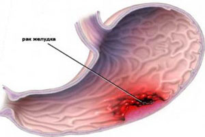 як лікувати рак шлунка