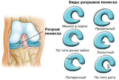 розрив заднього рогу меніска