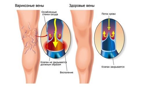 як лікувати варикоз ліками