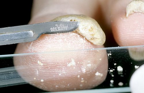 як вилікувати грибок нігтів за допомогою оцту
