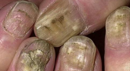 як вилікувати грибок нігтів за допомогою оцту