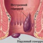 чи можна вилікувати геморой маззю