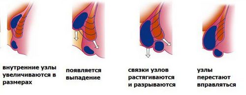 як вилікувати геморой свічки