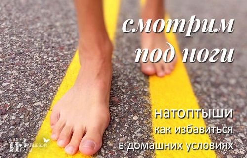 як лікувати натоптиші на ступнях в домашніх умовах