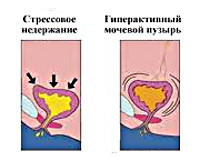 як лікувати виділення сечі