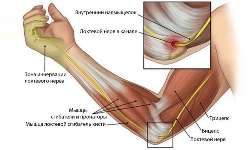 як лікувати забій ліктьового нерва