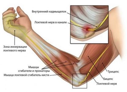 як лікувати забій ліктьового нерва