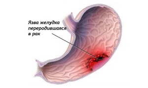 як лікувати рак шлунка після операції