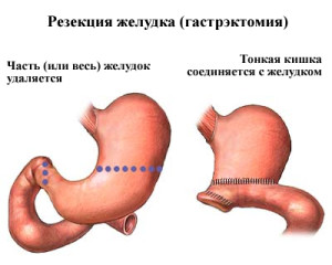 як лікувати рак шлунка після операції