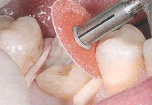 ниє зуб після лікування глибокого карієсу