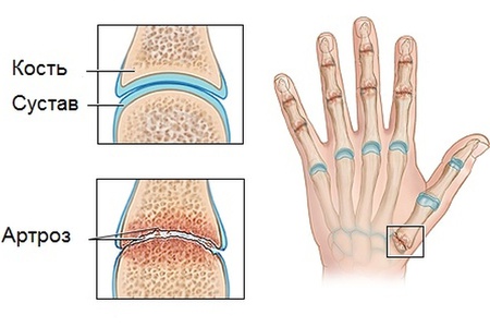 як лікувати артроз великого пальця руки
