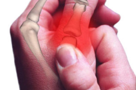 остеоартроз кисті рук лікування суглоби пальці деформуючий симптоми стадія народні засоби