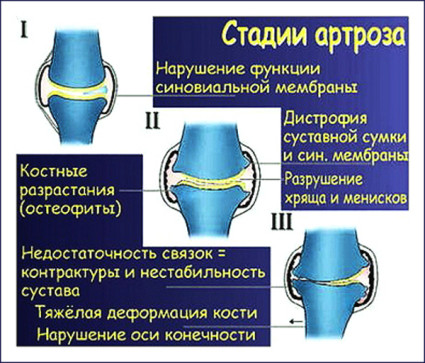 як лікувати остеоартроз колінного суглоба