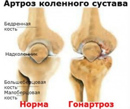 остеоартроз колінного суглоба 2 ступеня лікування народний засіб лікувати лівий
