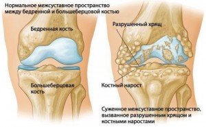 як лікувати остеохондроз колін