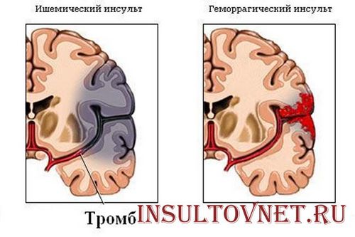 ніж лікувати інсульт головного мозку