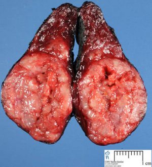 папілярний рак щитовидної залози скільки живуть