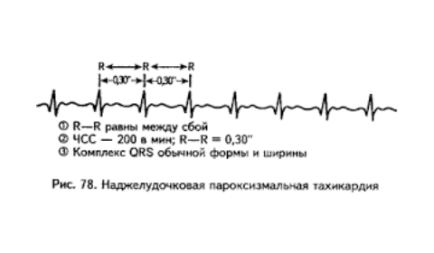 як лікувати пароксизмальну тахікардію