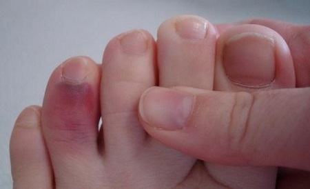 лікування перелому пальця на нозі