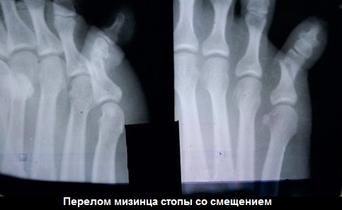 симптоми перелому пальця стопи