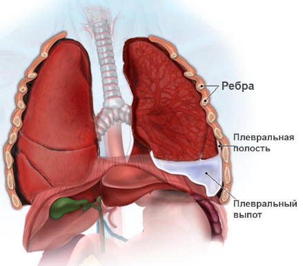 як лікувати плеврит легких