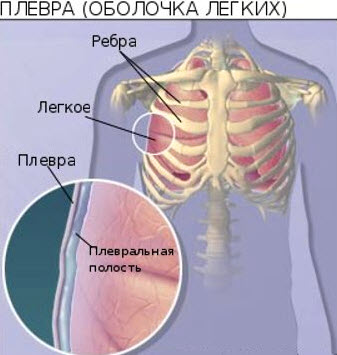 як лікувати плеврит легких